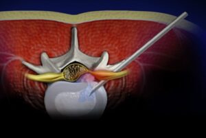 Minimally Invasive Cervical Spine Surgery