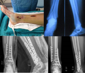 Minimally Invasive Fracture Fixation