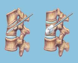 Vertebroplasty and Kyphoplasty